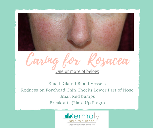 How To Care For Rosacea Skin
