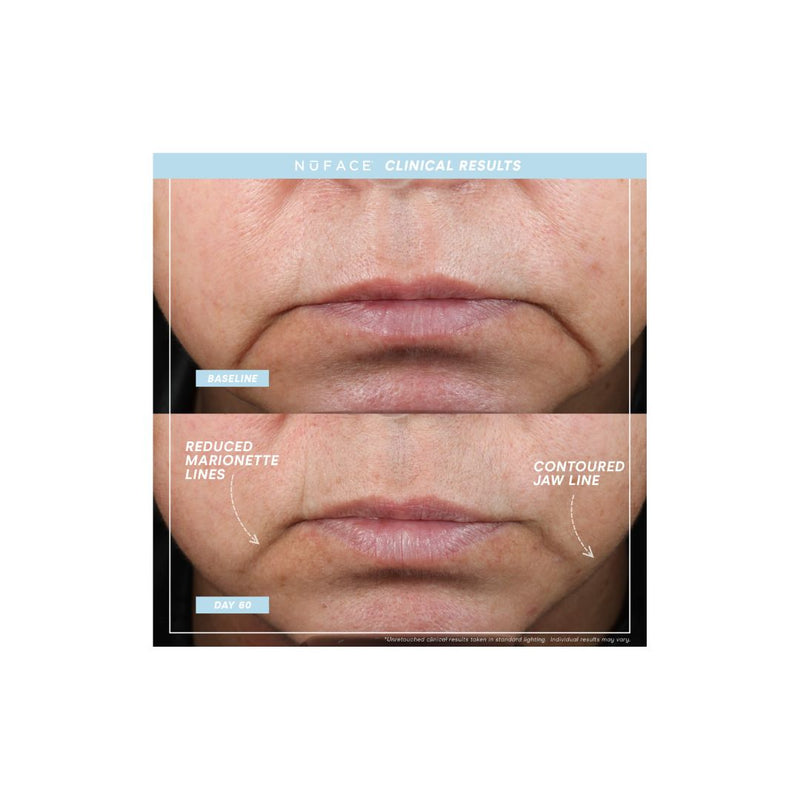 NUFACE Trinity+ Pro Smart Device Facial Toning Kit (Small Size Serums)