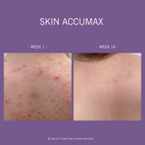 Skin Accumax TM