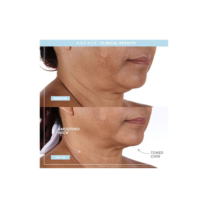 NUFACE Trinity+ Pro Smart Device Facial Toning Kit (Small Size Serums)